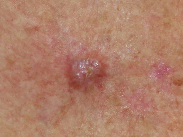 Most Common Skin Cancer in the UK – What to Look For May Surprise You.